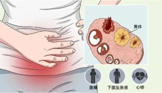 石家莊市第五醫(yī)院多學科聯(lián)合成功救治黃體破裂合并闌尾炎急腹癥患者